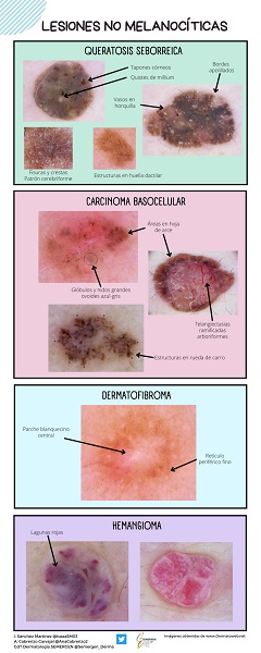 Dermatoscopia. Lesiones no melanocíticas