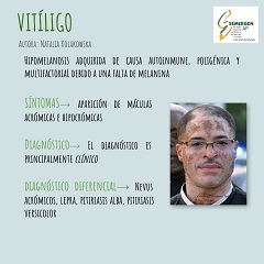 Vitiligo